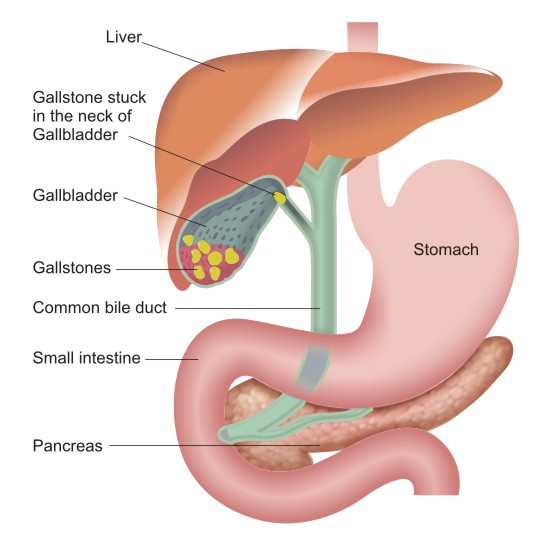 Gallbladder Stone