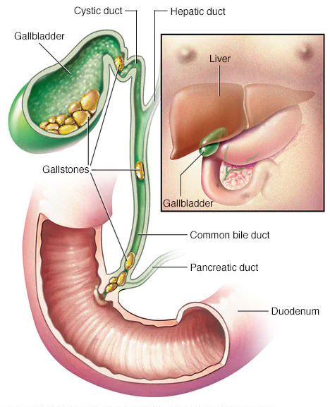 COMMON BILE DUCT STONE