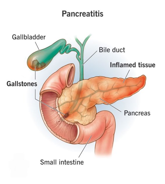 Acute Pancreatitis