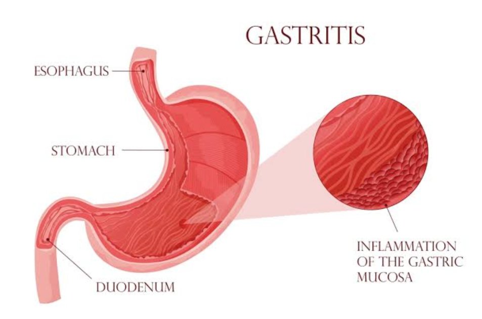 Gastritis