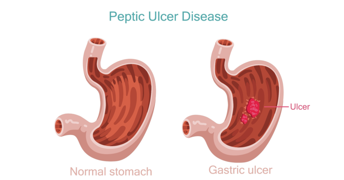 Gastric Ulcer