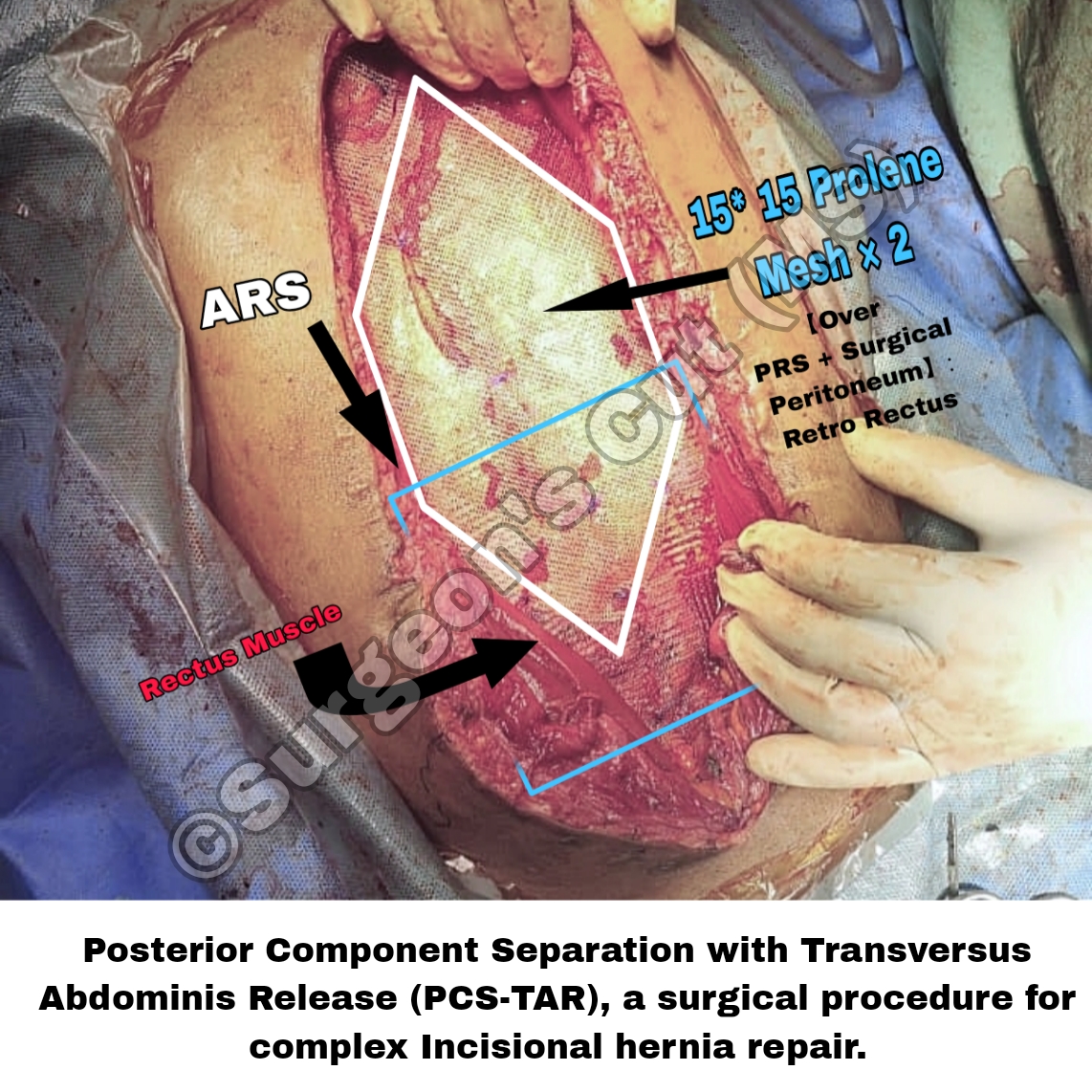 Giant Incisional Hernia